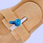 Cannula Fixator - Innova Fix